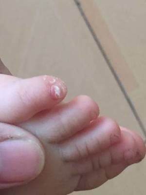 脚趾甲发白是怎么回事