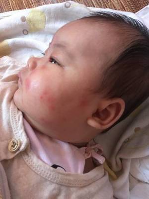 两个月宝宝过敏图片
