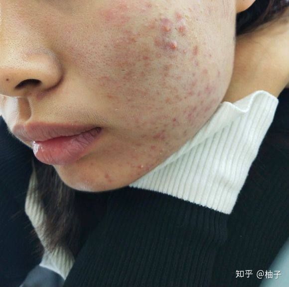 敏感肌肤痘痘发红