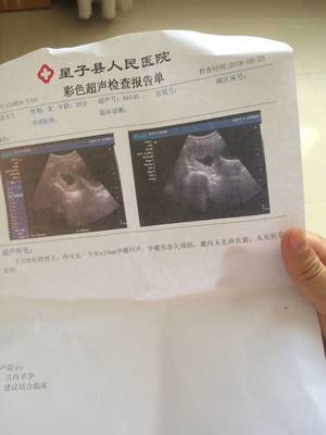 怀孕60天胚芽多大正常