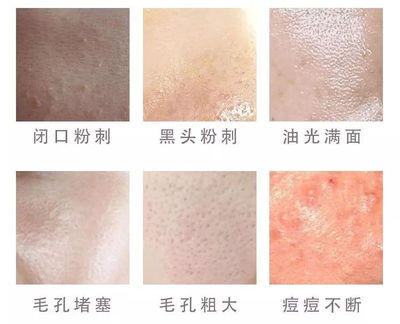 毛孔粗大有黑头粉刺怎么办