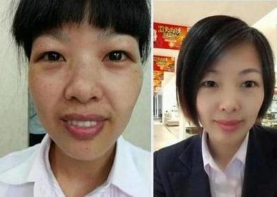 激光祛斑可以吃烧烤吗