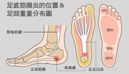 足底筋膜炎怎么治疗