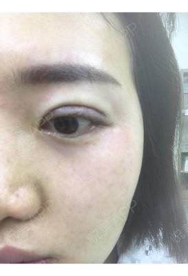 割双眼皮肿几天