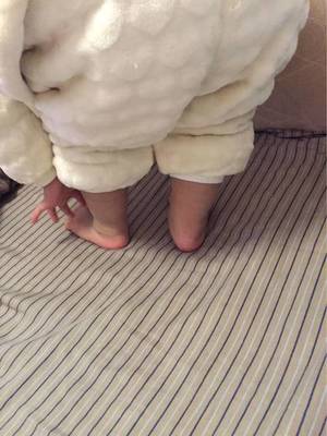 新生儿左脚外翻怎么办