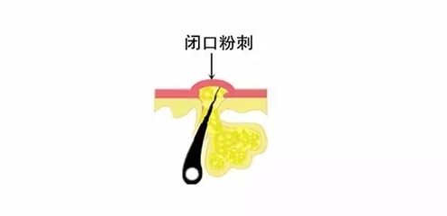 吃什么东西好不长痘痘