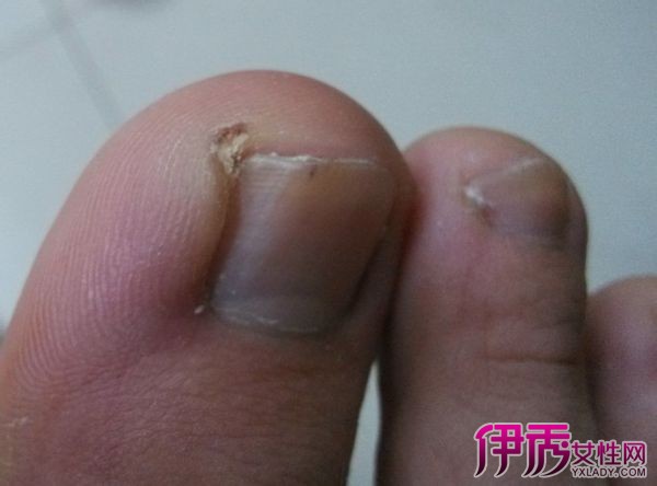 脚上长痘痘怎么消除它