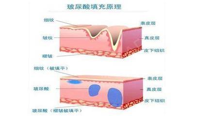 玻尿酸的区别