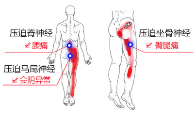 腰突怎么治疗