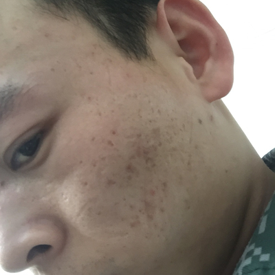 21岁男脸上长痘痘