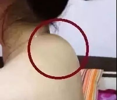 颈椎长个包是怎么回事