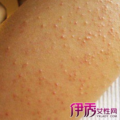 脸上毛孔一粒粒的凸起
