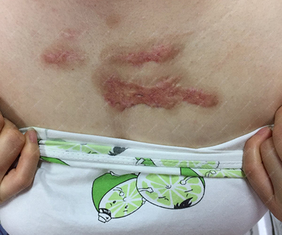 前胸长的痘痘会恢复吗