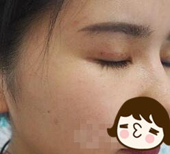 双眼皮可以自己拆线吗