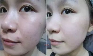 狮王化妆水痘痘变大了