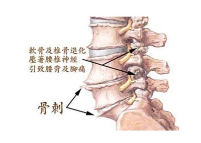 骨刺增生怎么治疗