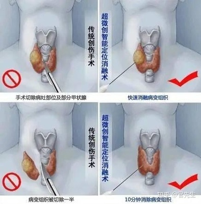 颈部结节怎么治疗