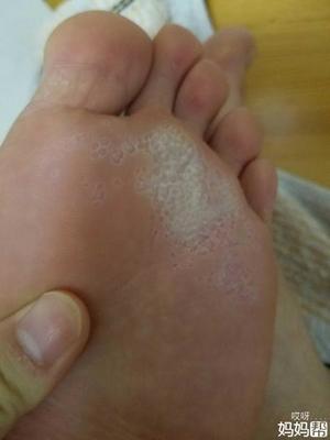 怀孕脚气怎么办