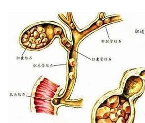 胆结石该怎么治疗