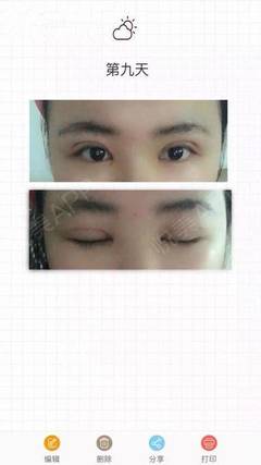 做双眼皮淤青多久能好