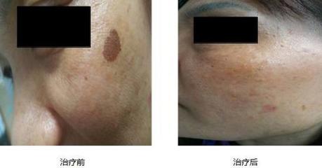 点阵激光治痘痘多少钱一次