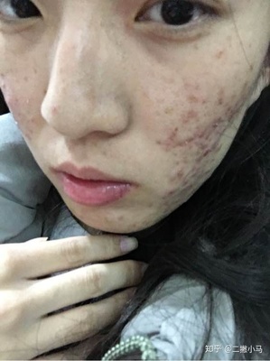 脓包型痤疮怎么治疗
