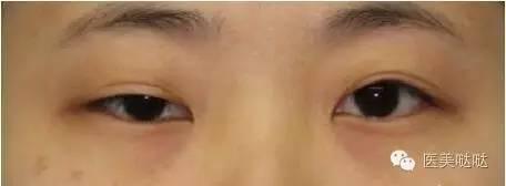 小眼睛适合做双眼皮吗