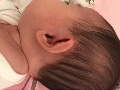 新生儿耳朵畸形无耳道