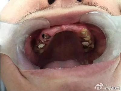 做梦牙烂了怎么回事
