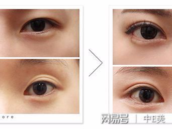 双眼皮哪种类型好看
