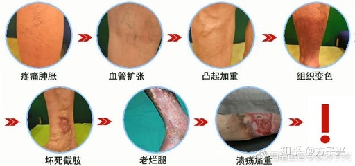 静脉曲张前期怎么治疗