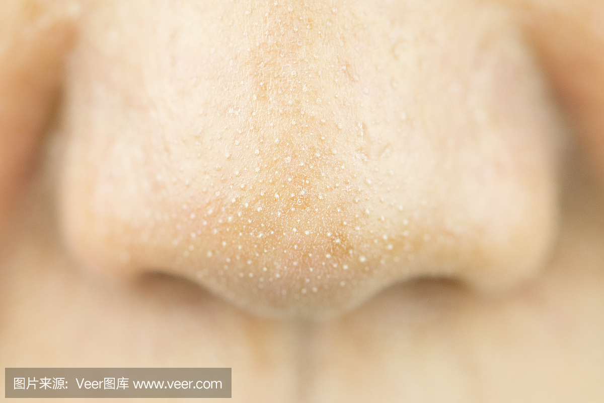 女孩鼻子上有小痘痘