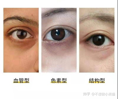 黑眼圈重是怎么回事