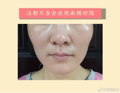 瘦脸针打50单位少了吗
