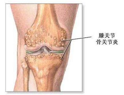脚板生骨刺怎么治疗