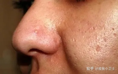 鼻翼总是长痘痘是什么原因