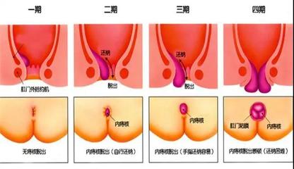 内痔二期怎么治疗