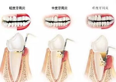 牙齿咬东西酸软无力怎么治疗