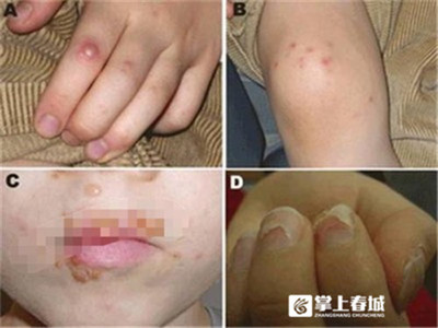 儿童皮疹怎么治疗