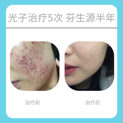 有痘痘用修复屏障