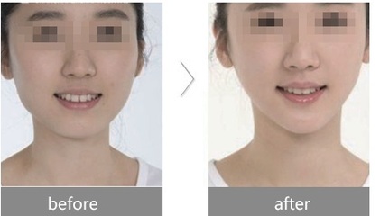 瘦脸针的作用是什么