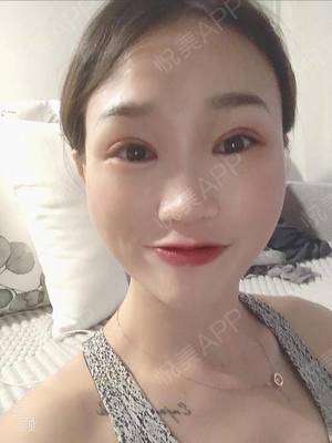 开眼角拆线后多久化妆