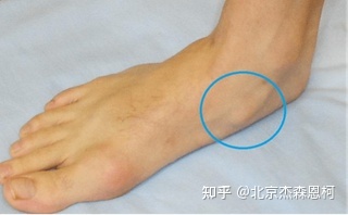 脚内侧疼是怎么回事