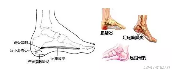 跖筋膜炎怎么治疗