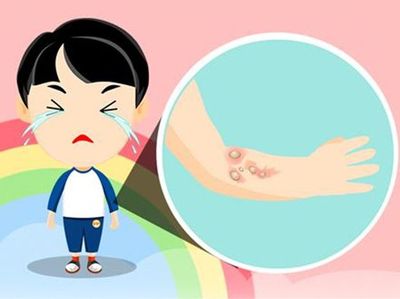 烫伤怎样不留疤痕