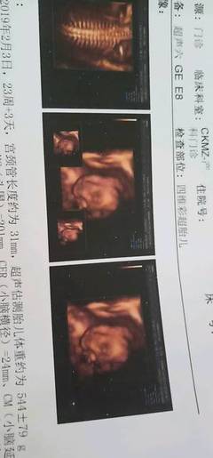 多少周估算胎儿体重