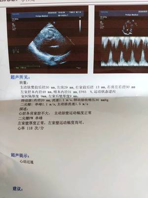 怀孕初期心率多少正常