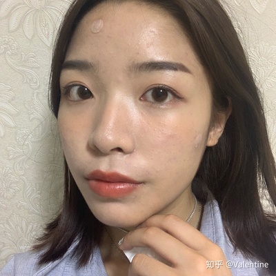痘痘没挤出来