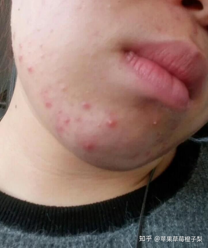 上火张痘痘疼