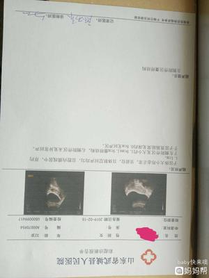 排卵期囊肿